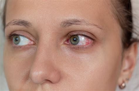 Do Contact Lenses Dry Your Eyes? - Calgary Family Eye Doctors