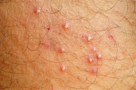FOLLICULITIS - Philippine Dermatological Society | Official Website