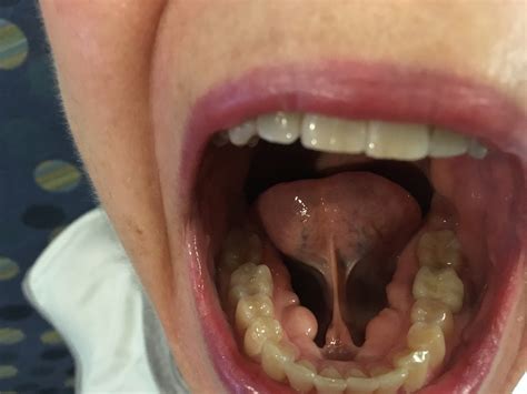 What Is Palatal And Mandibular Tori at Leah Woodcock blog