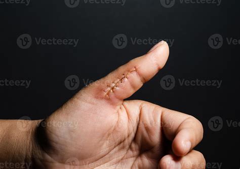 Close-up of a hand wound with stitches, thumb wound on black background ...