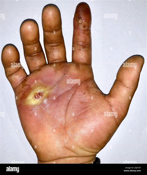 Staph Infection Vs Cellulitis at Elijah Rosa blog