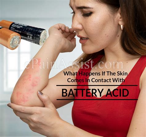 What Happens If The Skin Comes In Contact With Battery Acid & How To ...