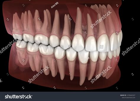Human Canine Teeth