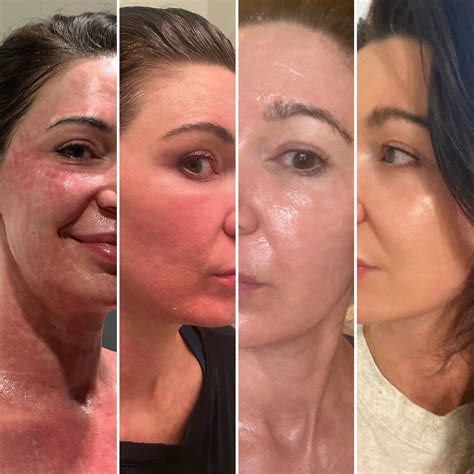 Skin resurfacing with Erbium Yag Laser - Beaty Facial Plastic Surgery