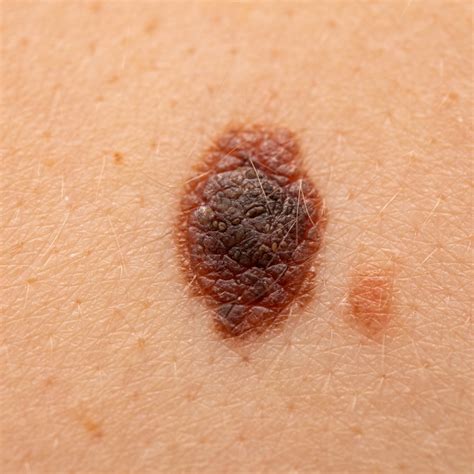 Seborrheic Keratosis Removal Gloucester - ProSkin Clinic & Health