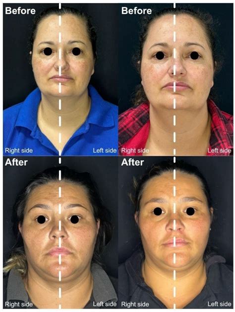 Comparative Study of Azelaic Acid Peeling vs. Tranexamic Acid ...