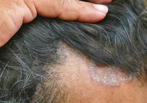 Seborrheic Dermatitis vs. Psoriasis of the Scalp