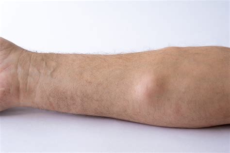 Verruca: Diagnosis, Cause and Treatment | Aventus Clinic