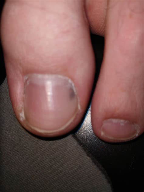 Black streaky mark under nail, something to be worried about? Just noticed it yesterday, no ...