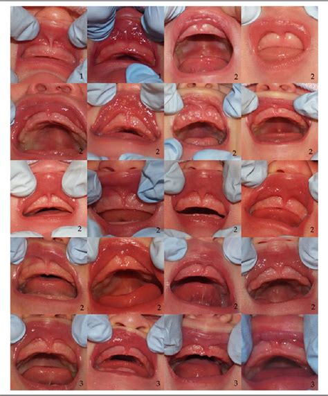 Figure 1 from The Superior Labial Frenulum in Newborns: What Is Normal ...