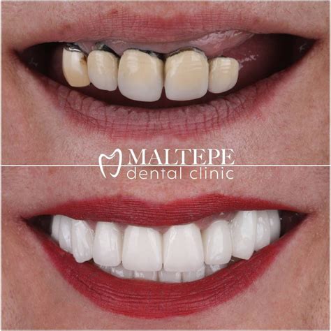 Porcelain Crowns Front Teeth