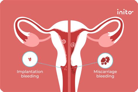 Miscarriage vs. Period: How to Tell If It’s a Miscarriage?