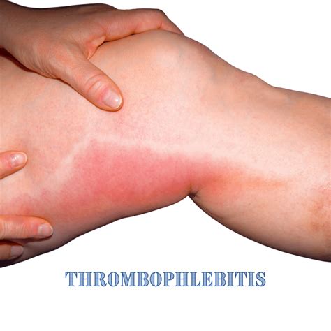 What Is Phlebitis