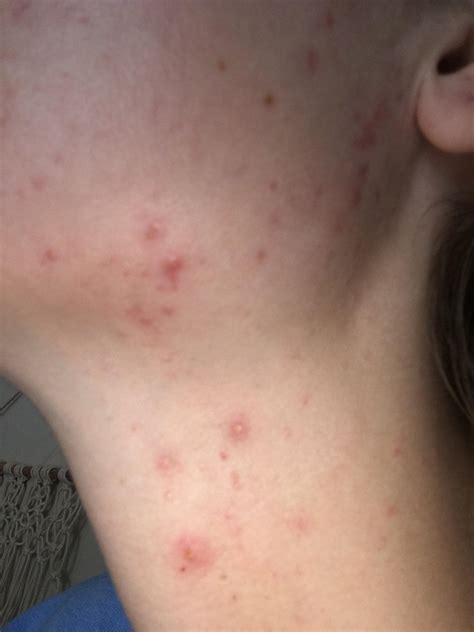 Pimple On Neck