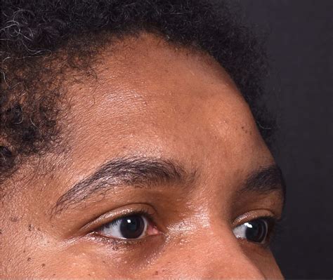 Lipomas & Osteomas Case 16203