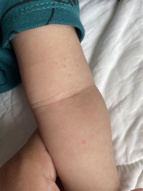 Bug bites on newborn? : r/bugbite