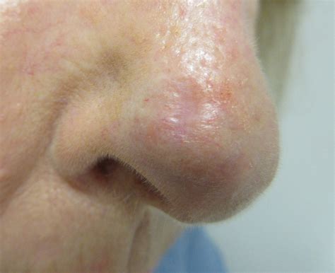BCC on The Nose – Basal Cell Carcinoma Picture | Mr Tehrani – Mohs Surgeon