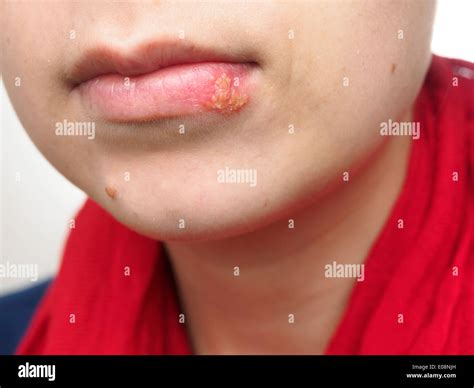 Lips With Herpes Simplex at Betty Mcclusky blog