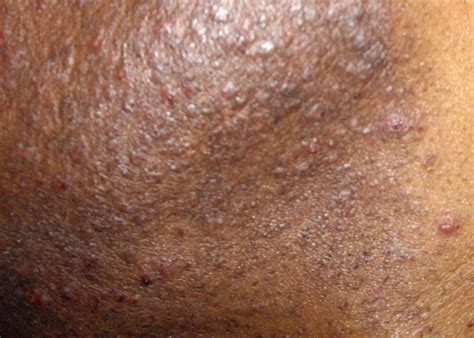 How to Prevent Razor Bumps on Neck – My Beard Gang