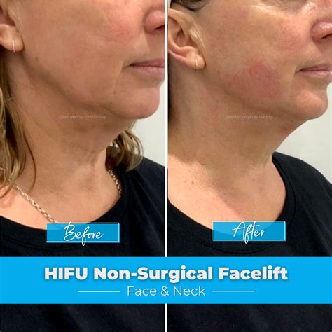 HIFU Non-Surgical Facelift | Sydney | Elite Body Contouring