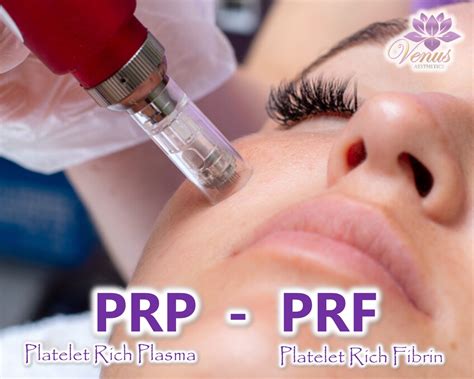 Venus Aesthetics & Skin – PRP Platelet Rich Plasma PRF Platelet Rich Fibrin – Clinica IDEAL Harwin