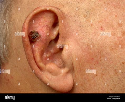 Squamous cell carcinoma ear hi-res stock photography and images - Alamy