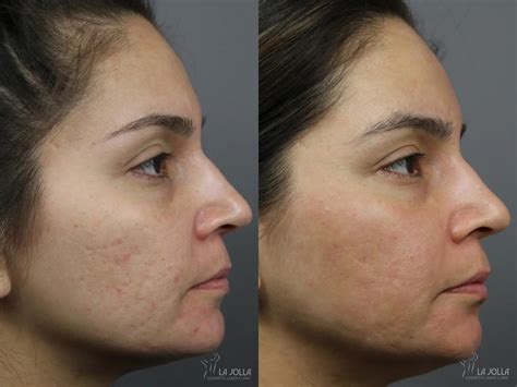 Acne: Laser Treatment Before & After Gallery: Patient 5
