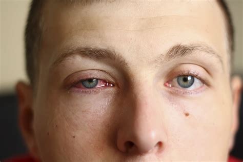 How To Get Rid Of Eye Swelling From Allergic Reaction at Odessa ...