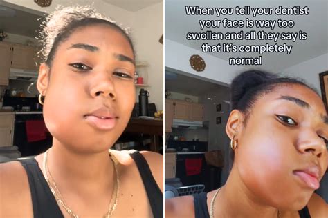 Wisdom Teeth Swelling Wisdom Teeth Hobart Orofacial Pain And Special