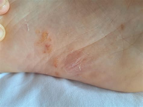 Hi all :) this is the bottom of my foot. Been and endless cycle for years of the small blister ...