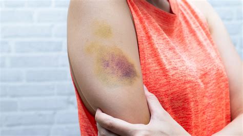 Why Do Bruises Itch? - GoodRx