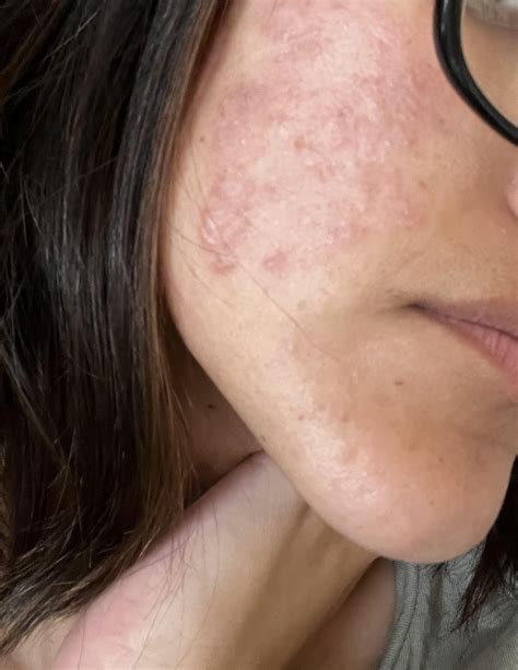 Birth control, Antibiotics, and Tea Tree Oil : r/Rosacea