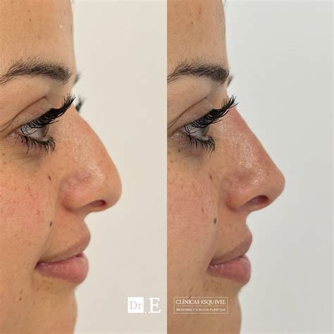 Buena Operación De Nariz Antes Y Después Fotos Rinoplastia Antes Y