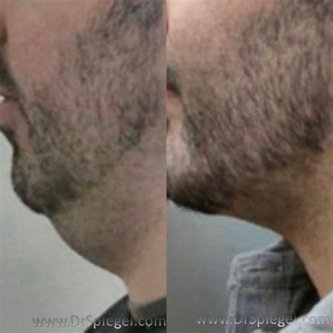 Did you know if your chin is too small you can add a chin implant from ...