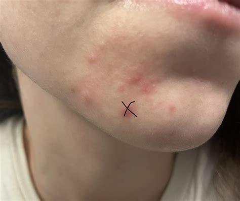 Rash on my chin : r/DermatologyQuestions