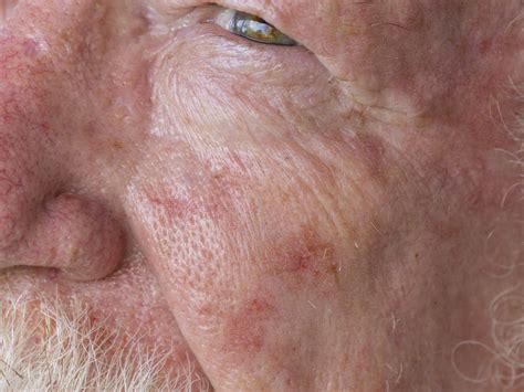 What Happens If Actinic Keratosis Is Left Untreated? – Balmonds