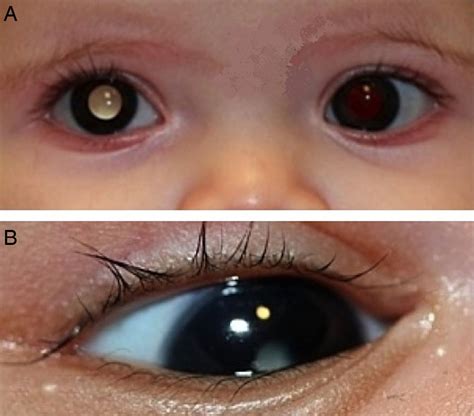 Leukocoria In Infants