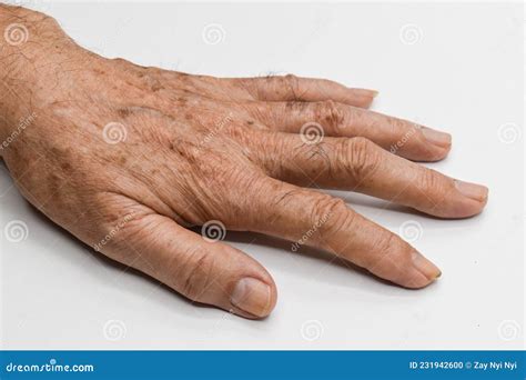 Age Spots on Hand of Asian Elder Man. they are Brown, Gray, or Black Spots and Also Called Liver ...