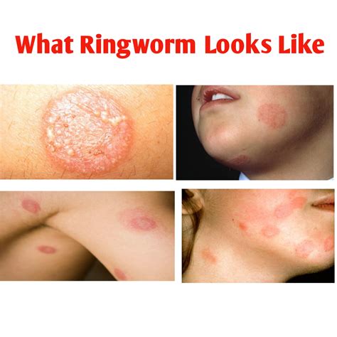 Stages Of Ringworm