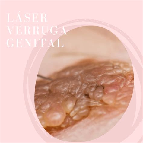 Por Qué Salen Verrugas En El Glande - ZHERSS