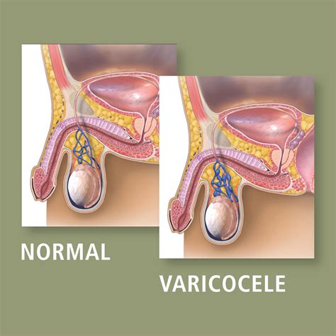 Varicocele Vs Normal Spermatic Vein Ligation What You Need To Know