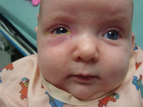 Baby Swollen Eye Blocked Tear Duct at Frank Thill blog