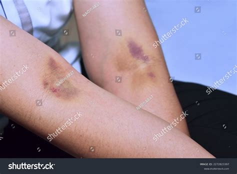 Bruising After Blood Draw Drug Allergy Stock Photo 2272823397 ...