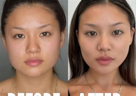 Buccal Fat Removal Before and After - Before After Journey