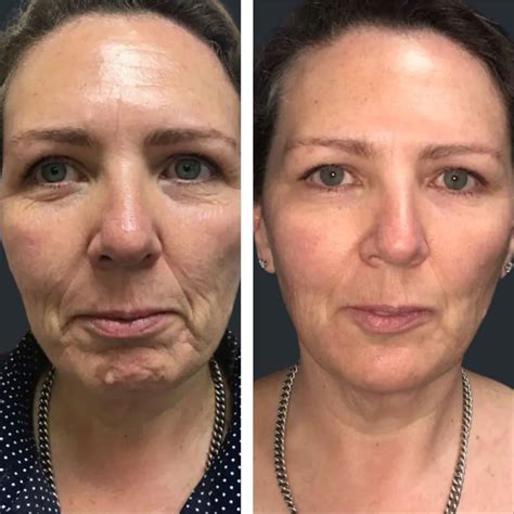 Marionette Line Treatment Brisbane | Marionette Lines Filler, PDO Threads