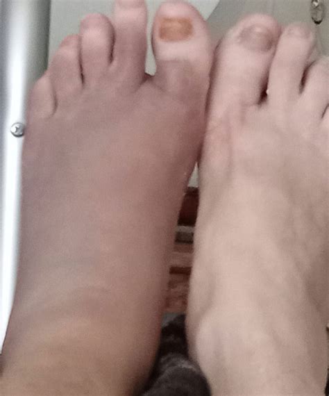 3 Treatments for Foot Swelling After Total Knee Replacement Surgery ...