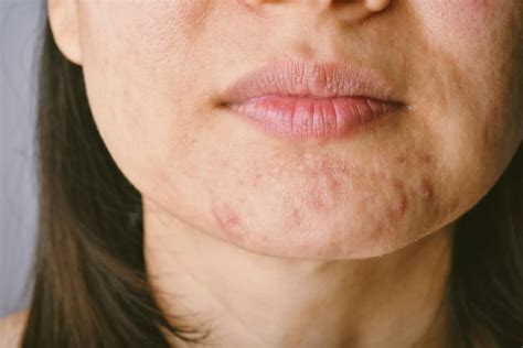Chin Breakout Causes & Jawline Acne: What's Behind It?