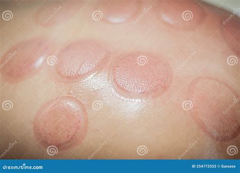 Red Marks, Cupping Therapy, Vacuum Spots on Woman Back Stock Image ...