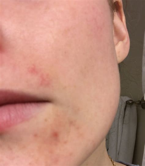 I Started Getting Perioral Dermatitis: Here's How I am Treating It — The Health Mason
