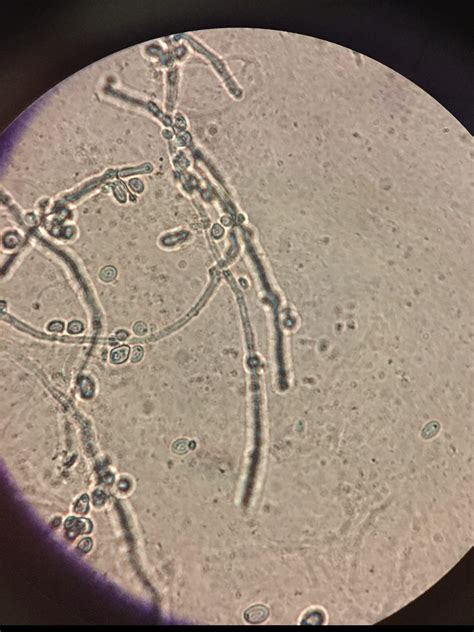 When a yeast infection won't go away - by Dr. Jen Gunter